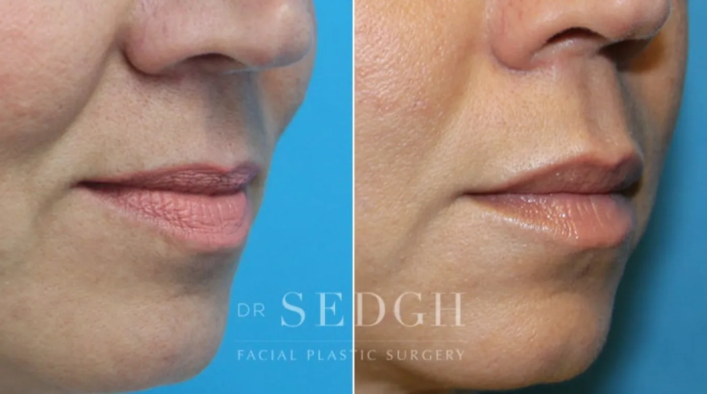 Patient 2 before lip augmentation, view 1