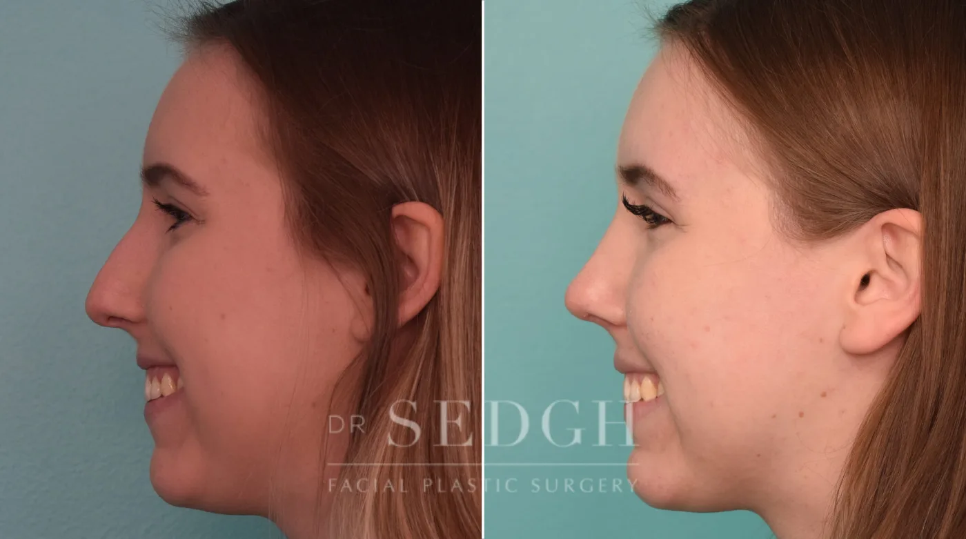Patient 226 after Facial Fillers, view 1