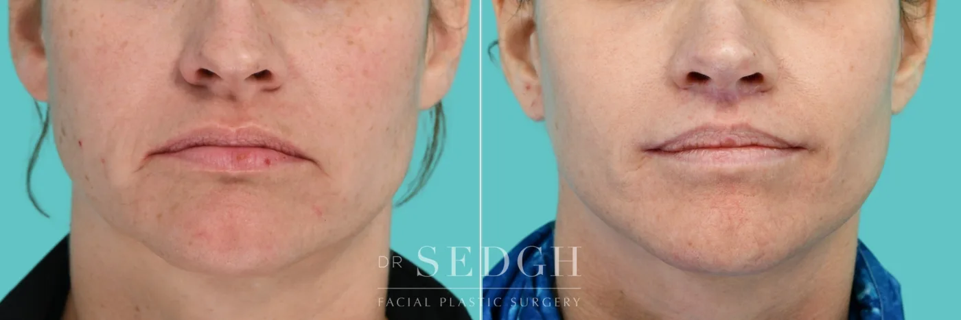 Patient 352 before Lip Lift, view 2