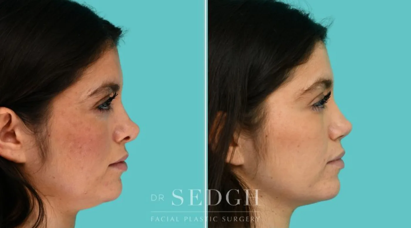 Patient 365 before Revision Rhinoplasty, view 2