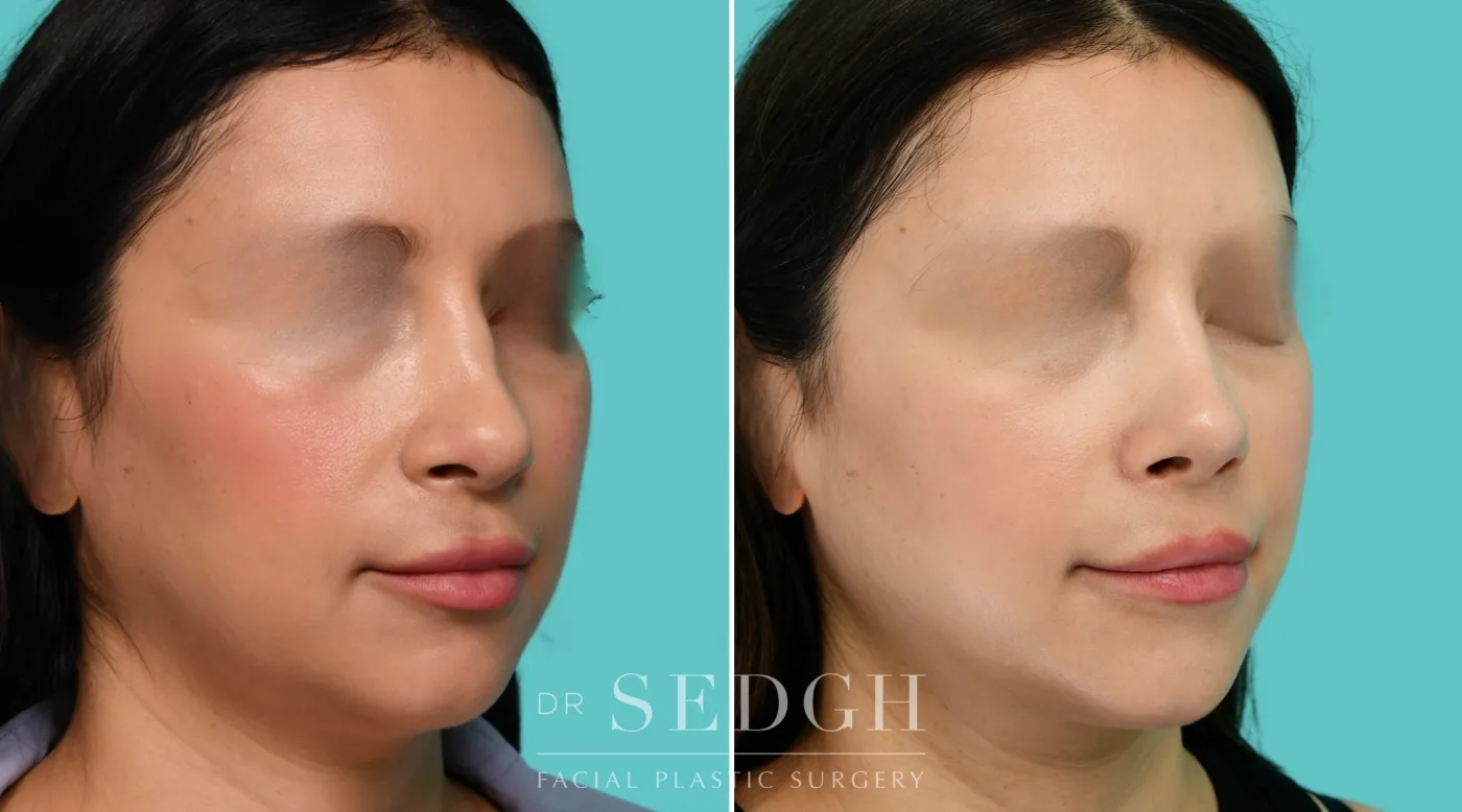 Patient 354 before Revision Rhinoplasty, view 3