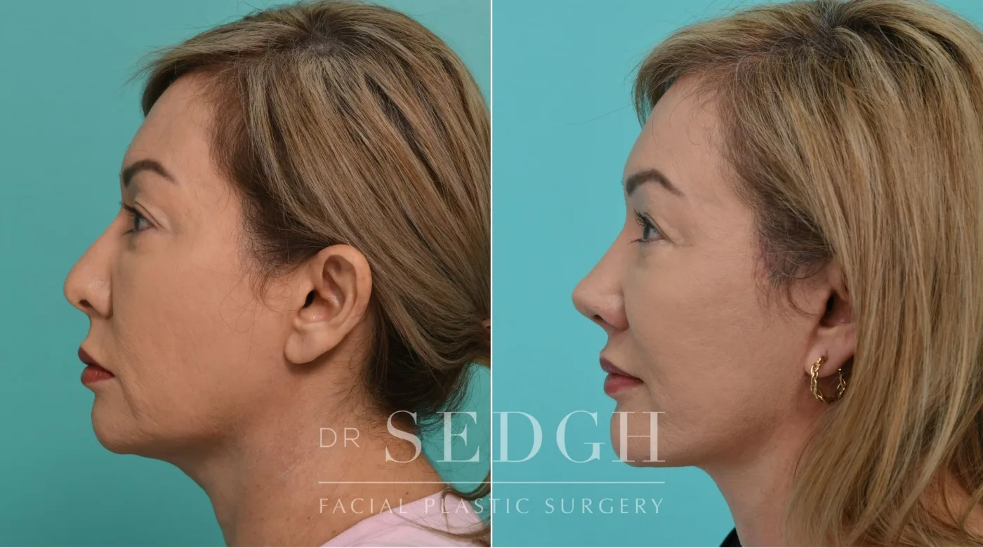 Patient 341 after Face Lift, view 2