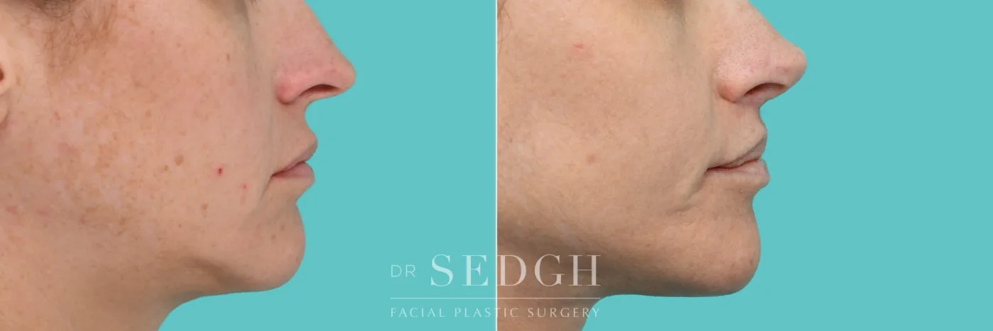 Patient 352 after Lip Lift, view 1