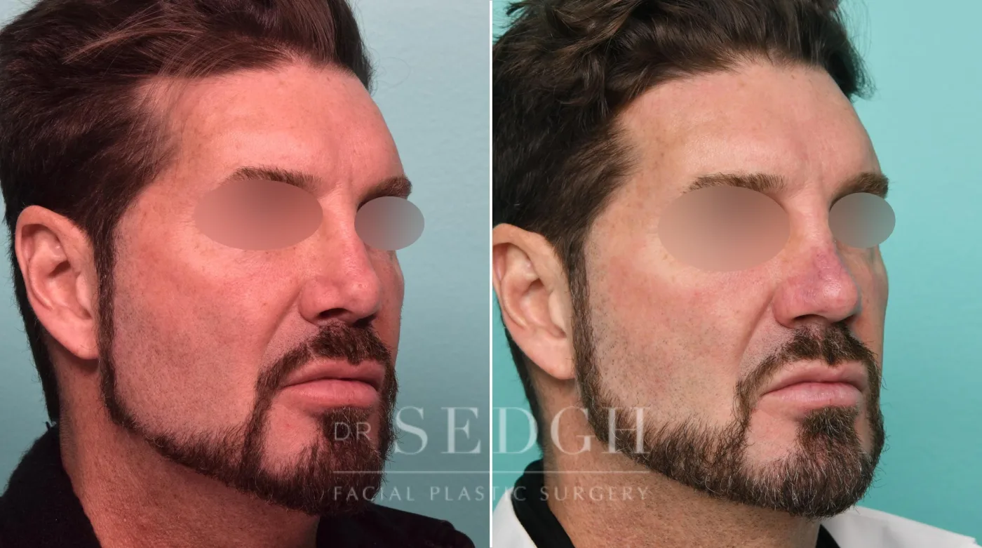 Patient 309 before Neck Liposuction, view 1