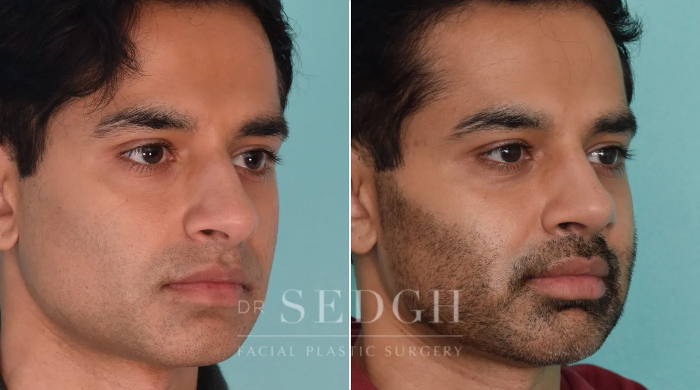 Patient 210 before Middle Eastern Rhinoplasty, view 1