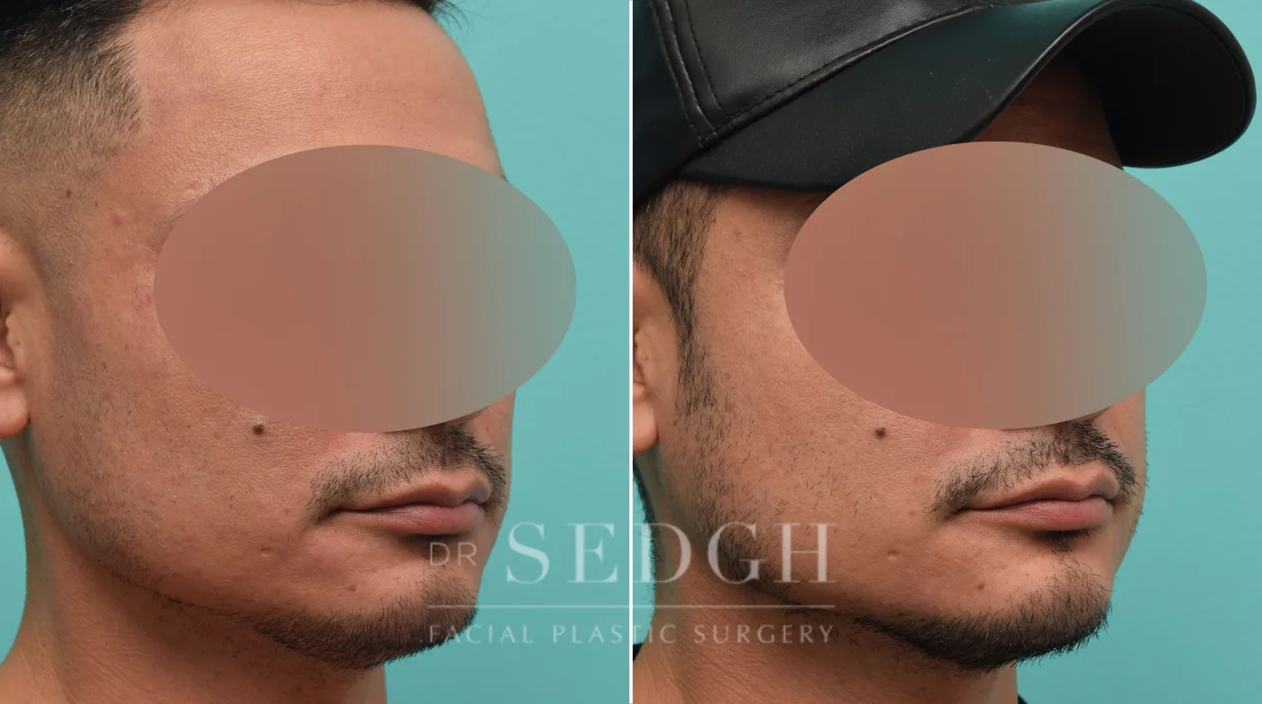 Patient 147 before Chin Augmentation, view 1