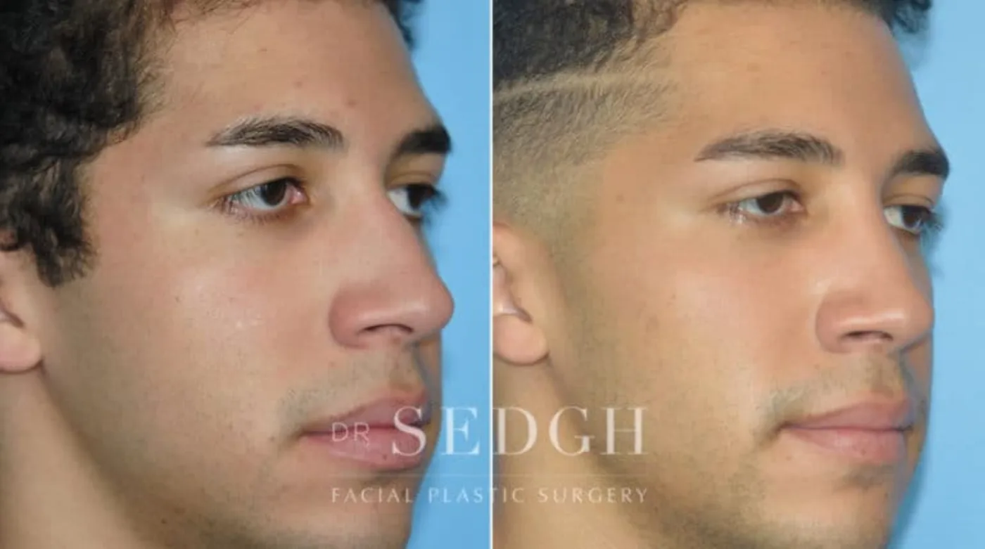 Patient 6 after Crooked Nose Surgery, view 1