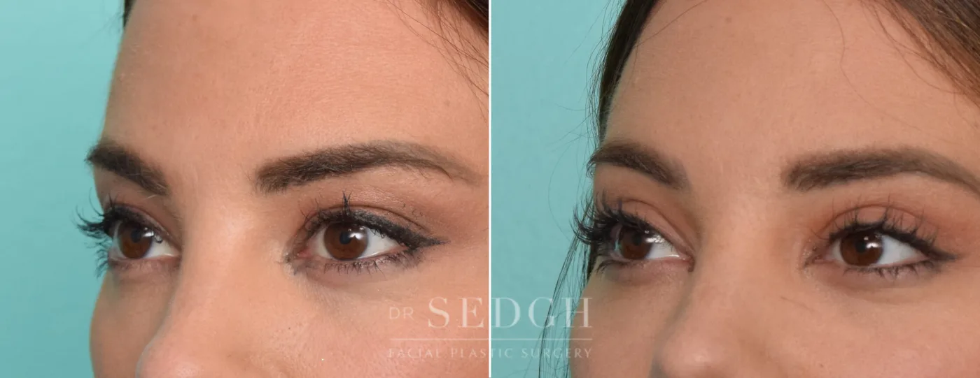 Patient 331 before Upper Blepharoplasty, view 1