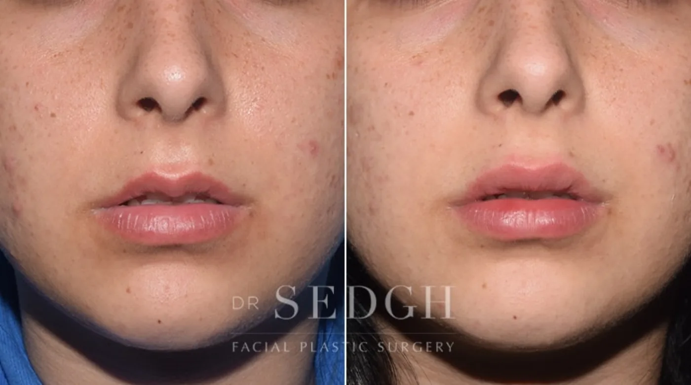 Patient 8 after lip augmentation, view 1
