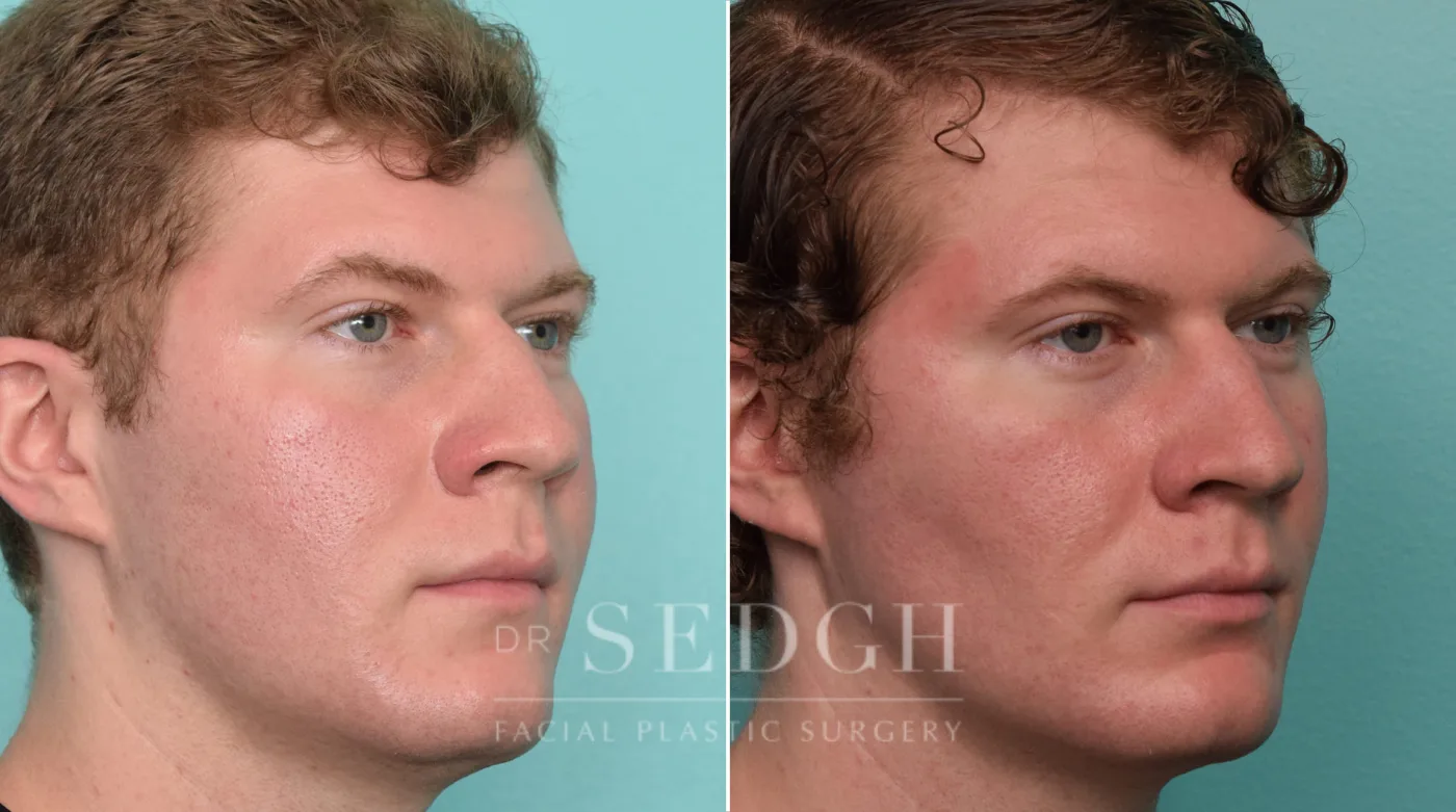 Patient 264 before Buccal Fat Reduction, view 2