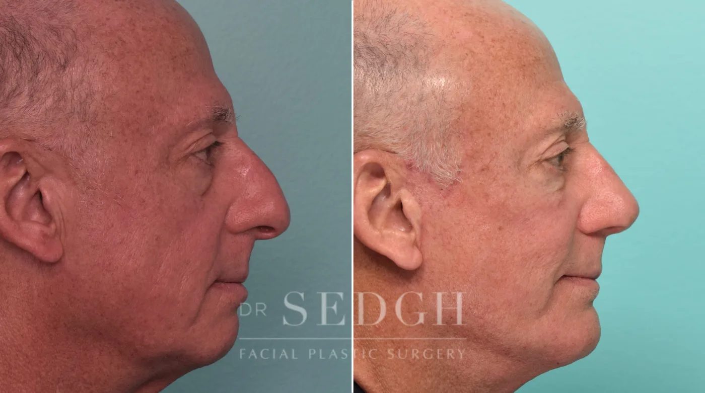 Patient 292 after Face Lift, view 1