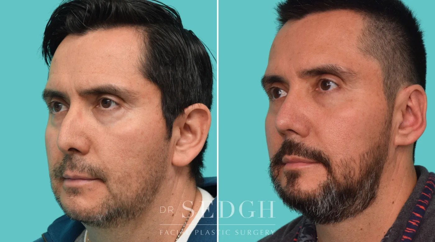 Patient 355 before Hispanic Rhinoplasty, view 2