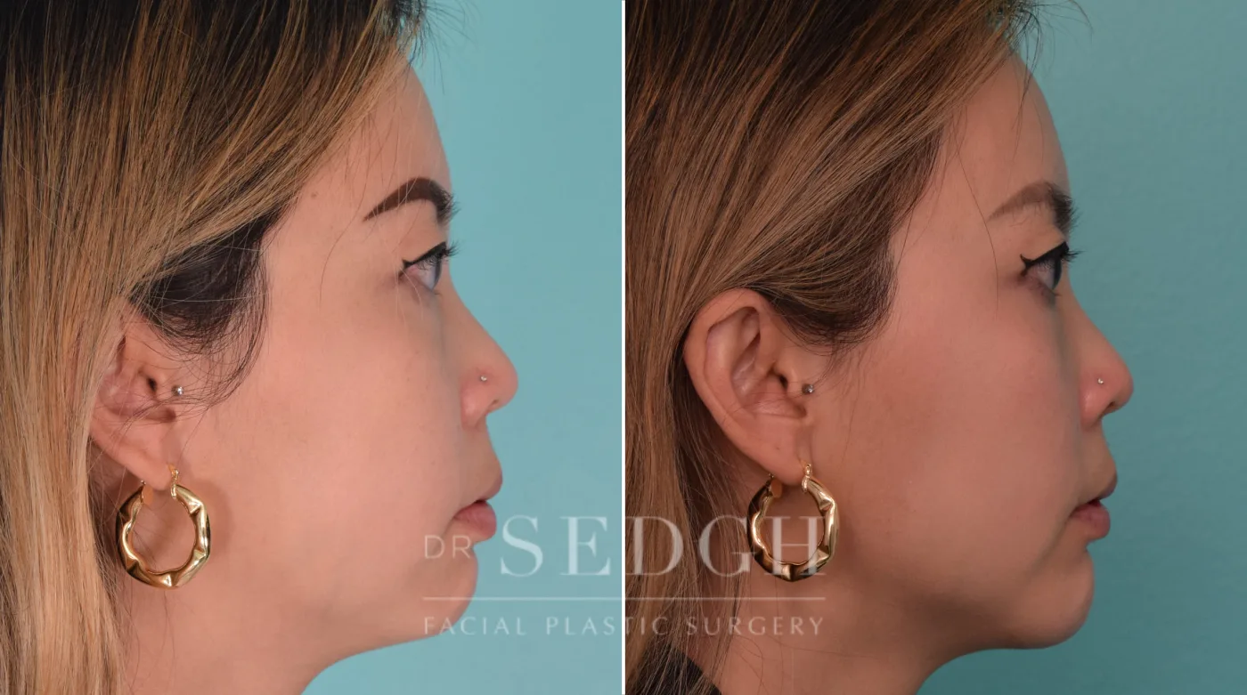 Patient 209 after Chin Augmentation, view 1