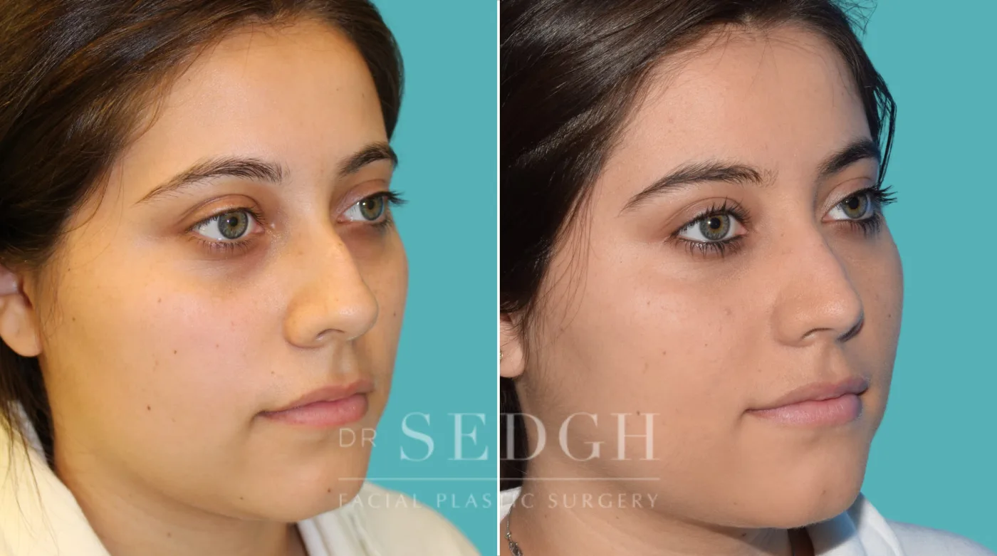 Patient 27 before Rhinoplasty, view 2