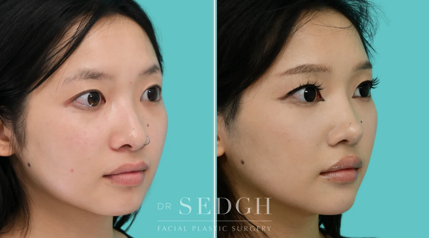 Patient 353 before Asian Rhinoplasty, view 3