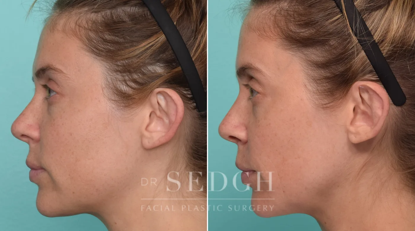 Patient 321 after Ear Pinning Surgery, view 2