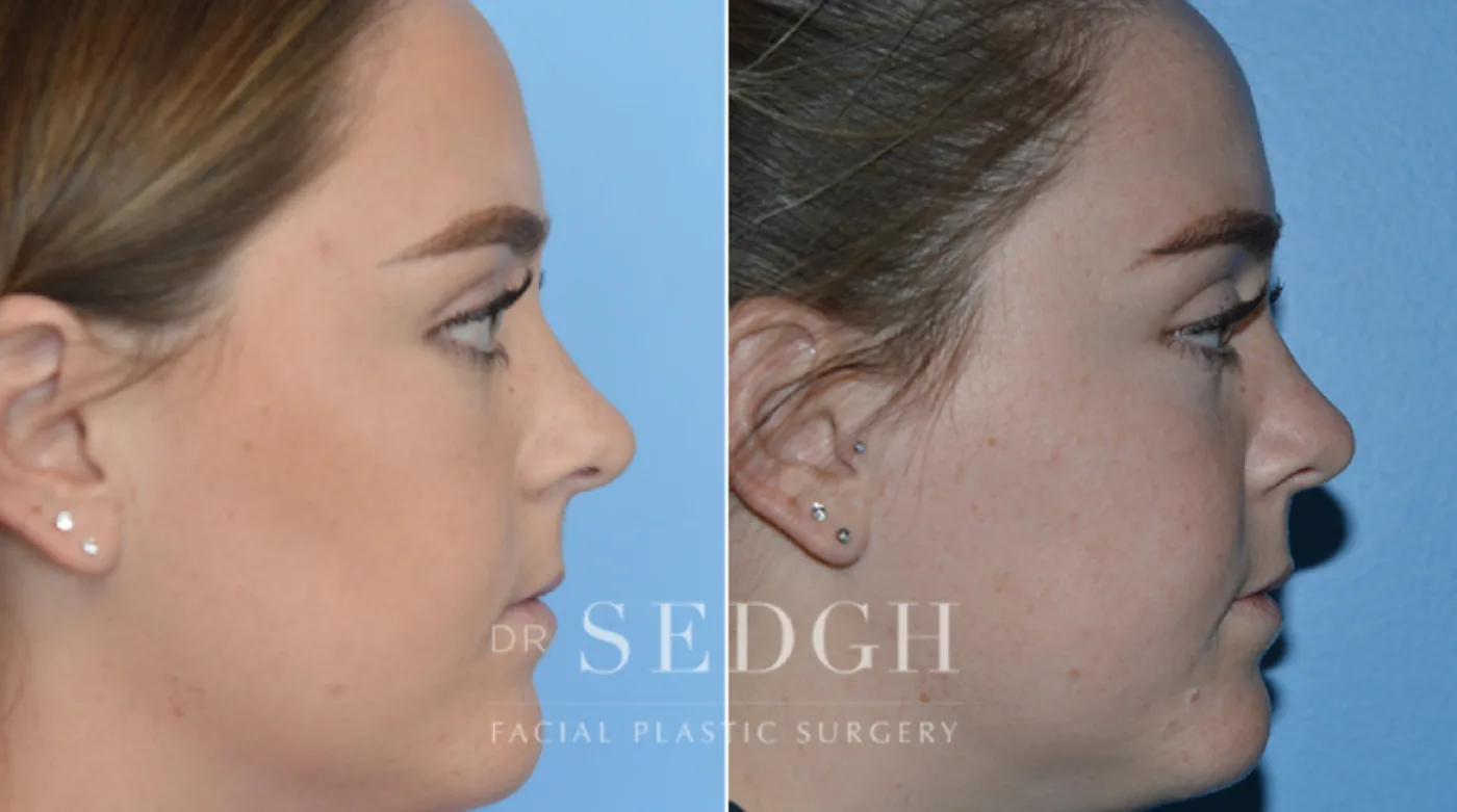 Patient 14 after Crooked Nose Surgery, view 1
