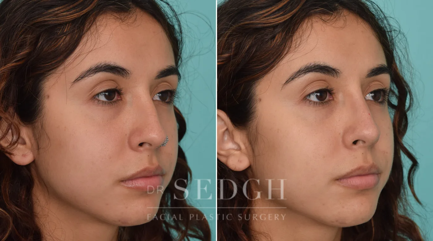 Patient 222 before Liquid Rhinoplasty, view 1