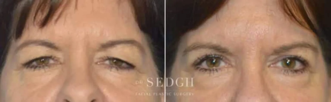 Patient 6 before Brow Lift, view 1
