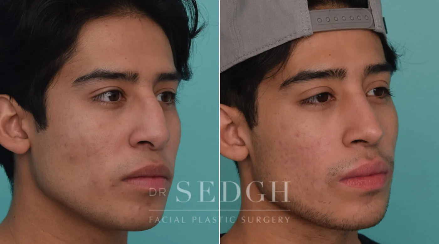 Patient 201 before Revision Rhinoplasty, view 1