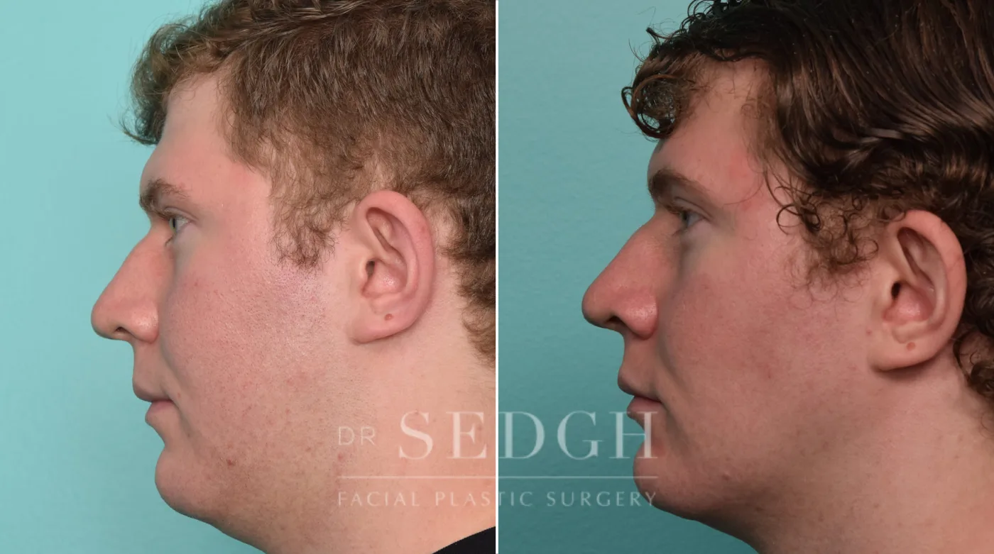 Patient 264 after Buccal Fat Reduction, view 1