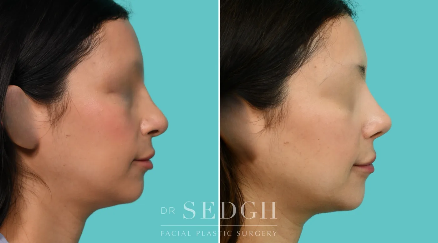 Patient 354 before Revision Rhinoplasty, view 2