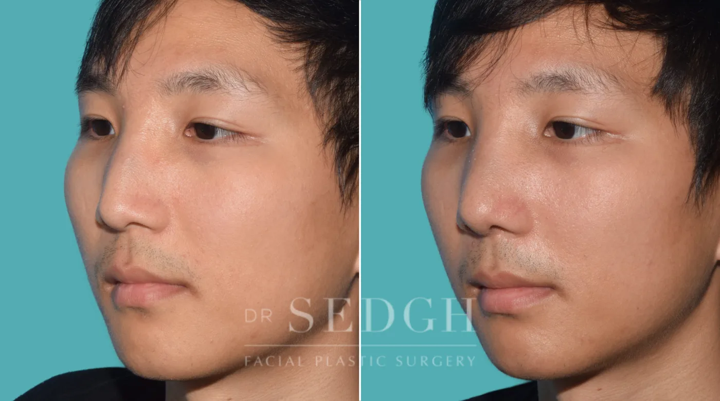 Patient 26 before Middle Eastern Rhinoplasty, view 2