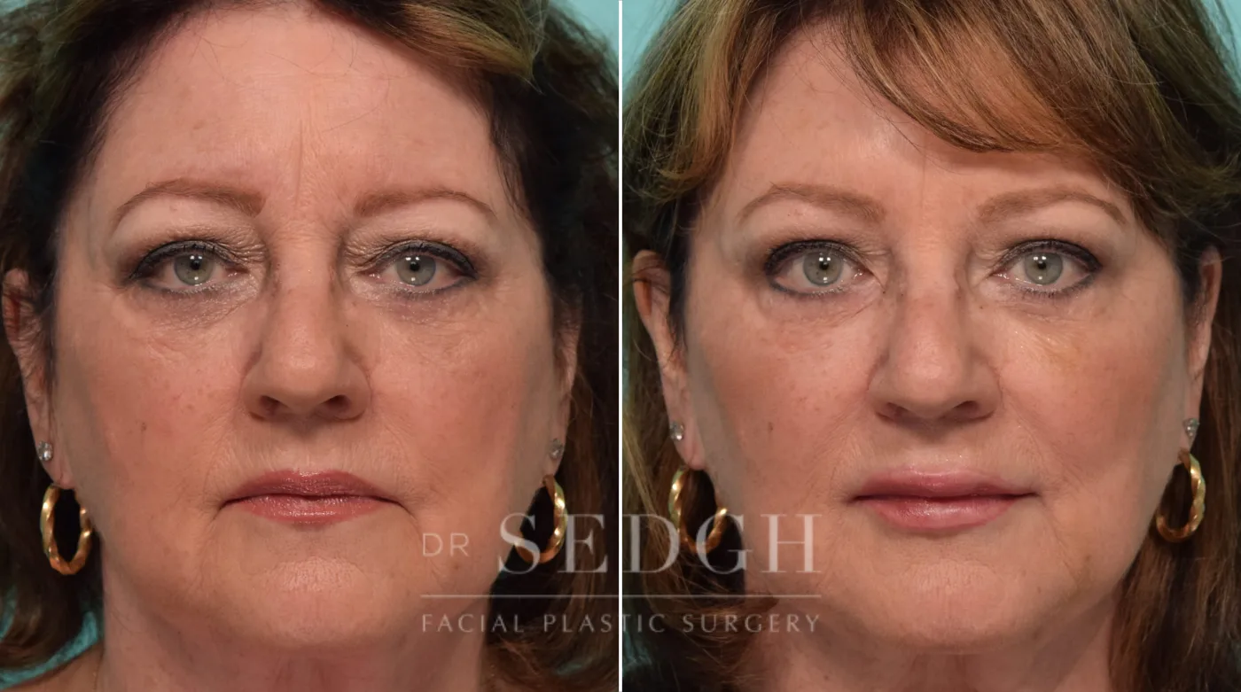 Patient 304 before Wrinkle Relaxers, view 1