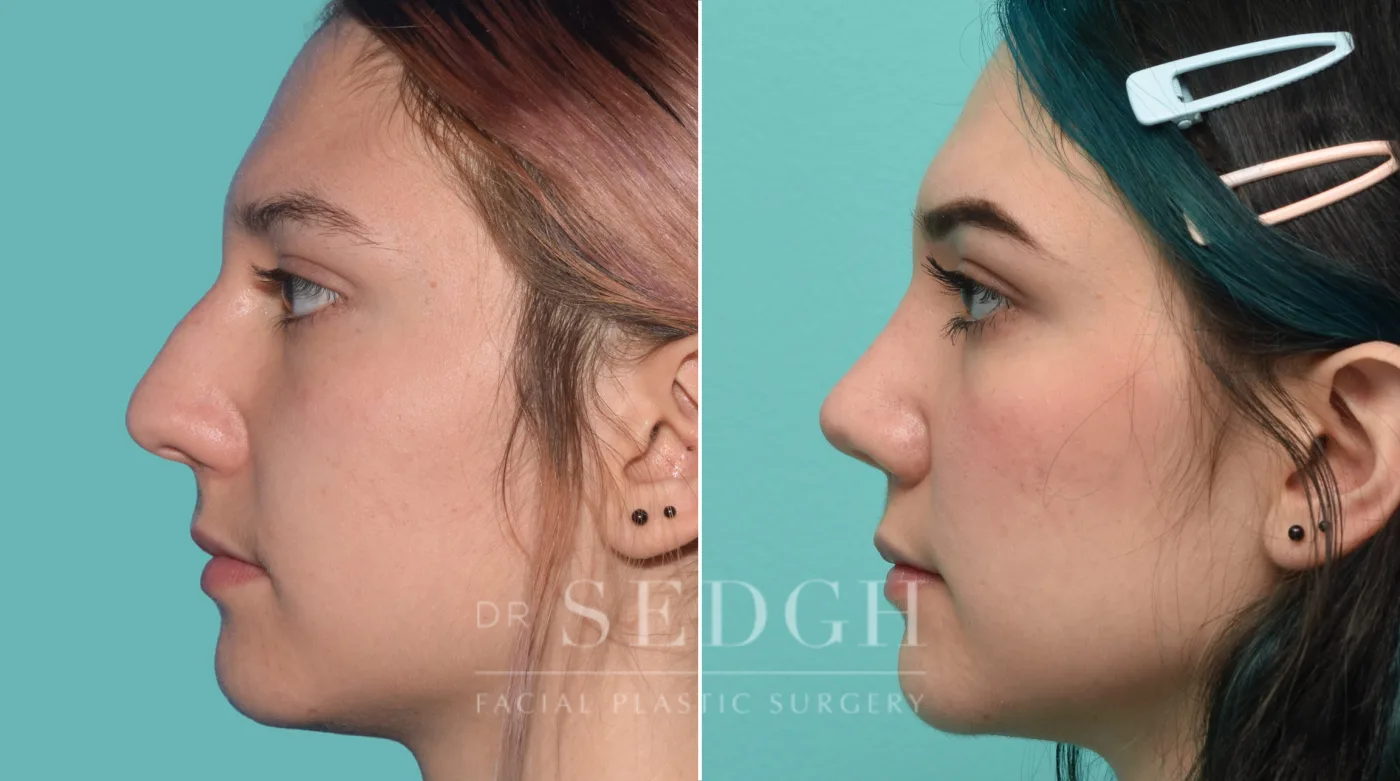 Patient 32 before Rhinoplasty, view 3