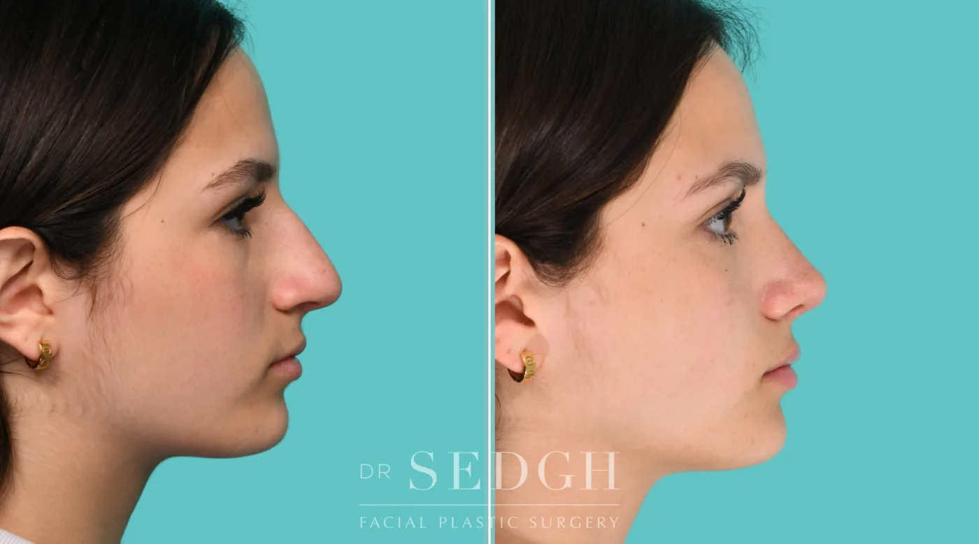 Patient 350 after Middle Eastern Rhinoplasty, view 4