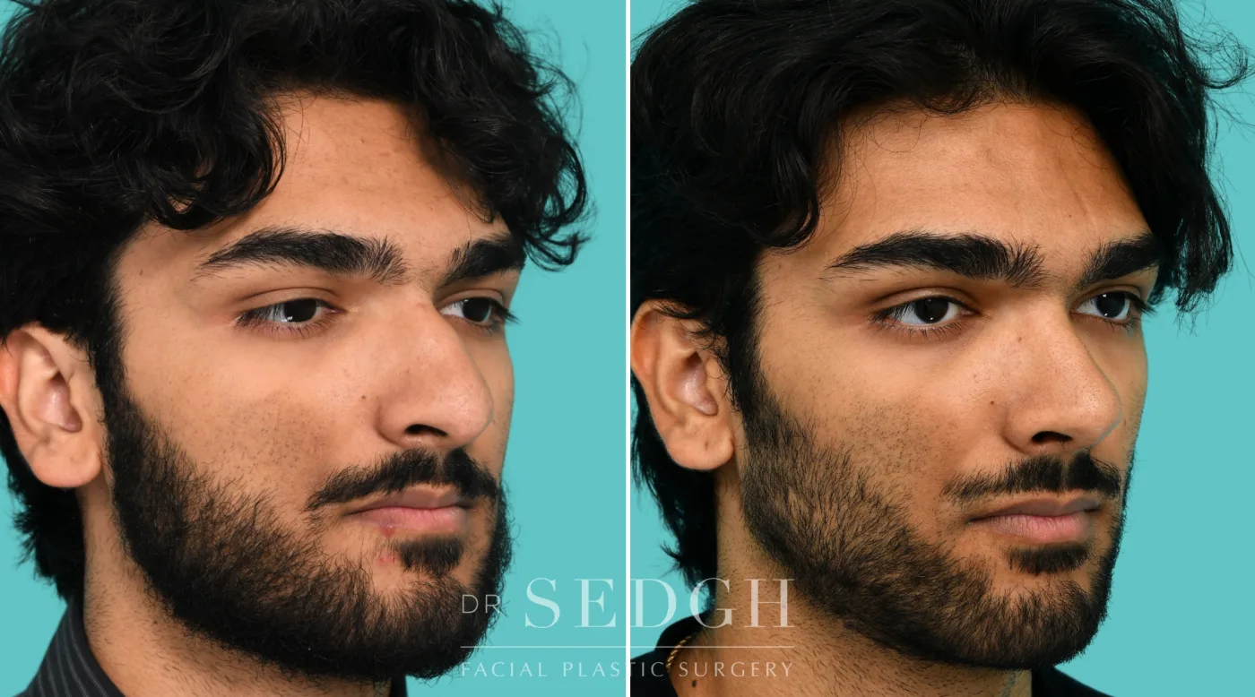 Patient 364 before Male Rhinoplasty, view 3