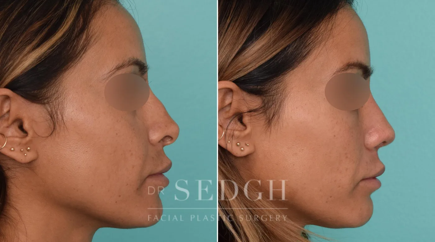 Patient 259 after Revision Rhinoplasty, view 1