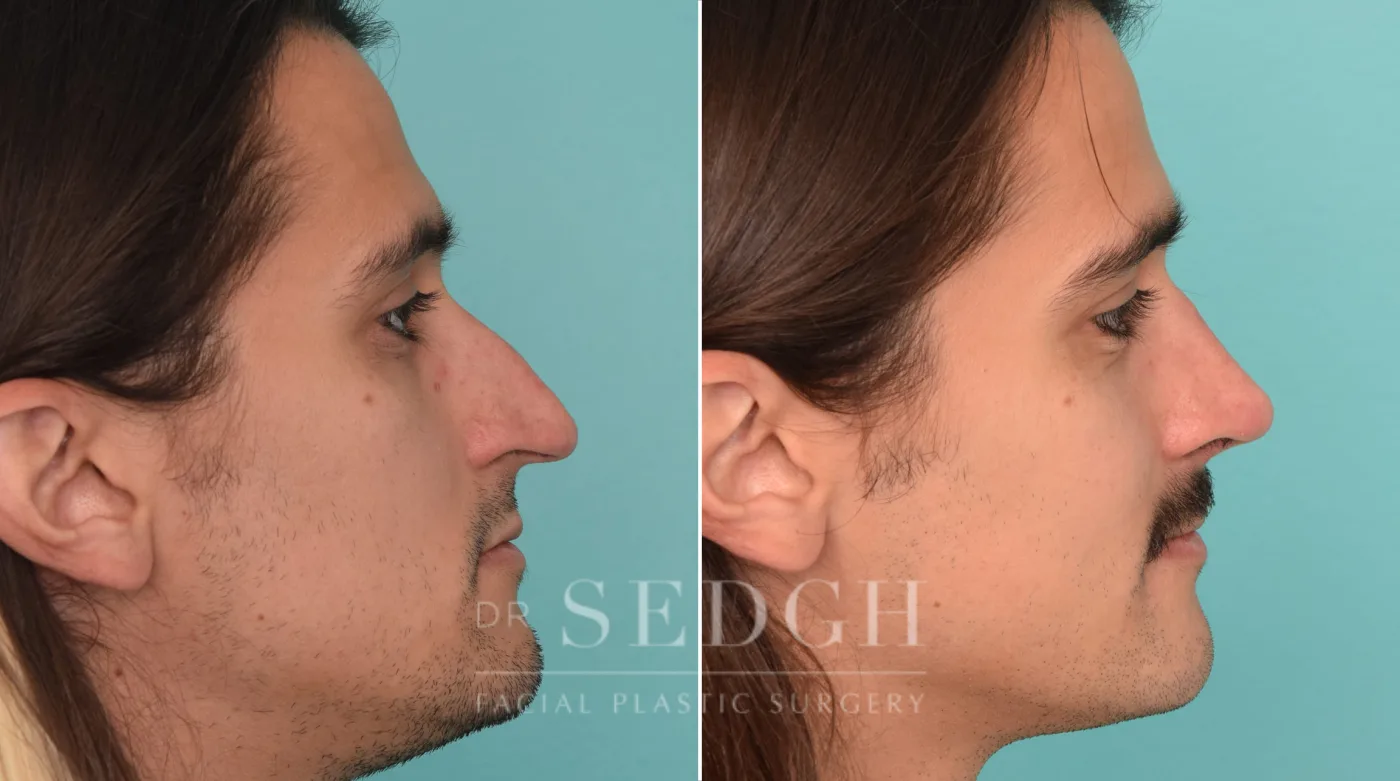 Patient 224 after Rhinoplasty, view 2