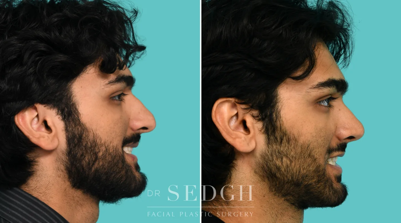 Patient 364 after Male Rhinoplasty, view 2