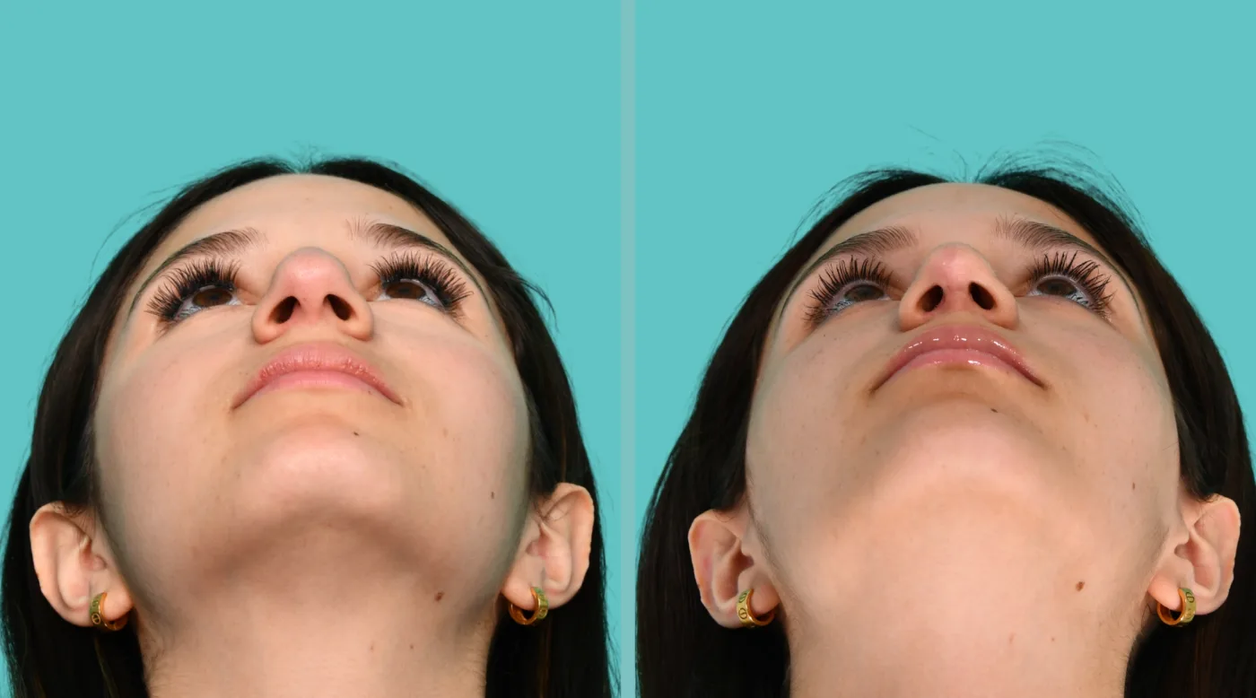 Patient 350 before Middle Eastern Rhinoplasty, view 2