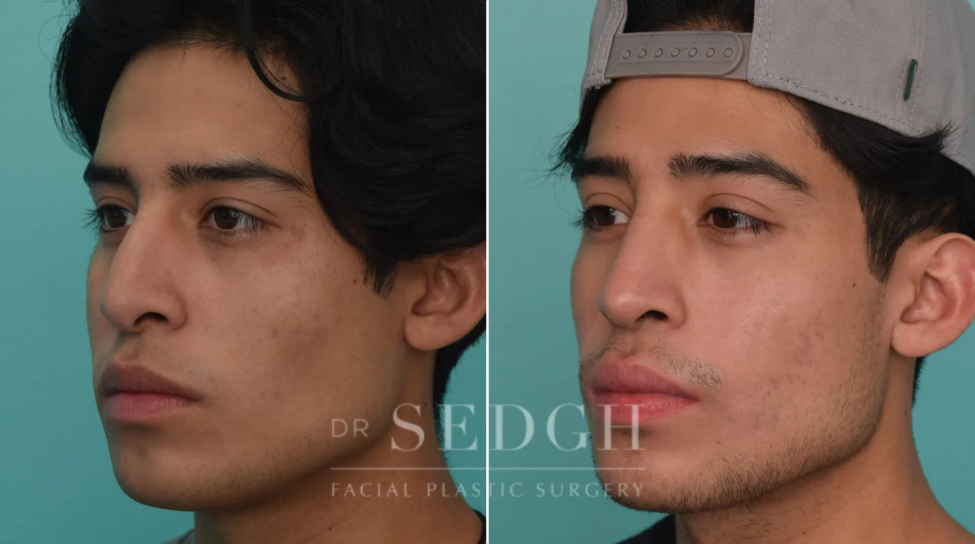 Patient 201 before Revision Rhinoplasty, view 2