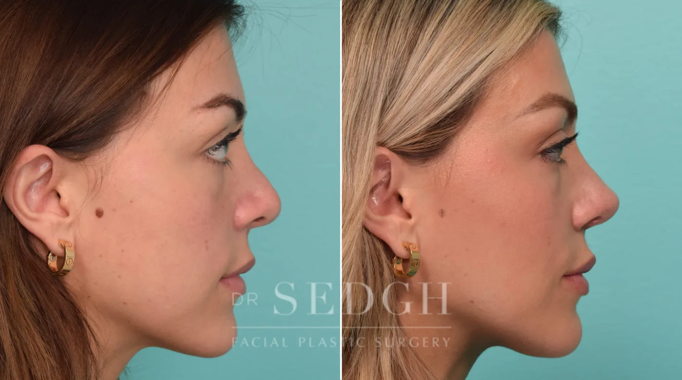Patient 279 after Revision Rhinoplasty, view 1