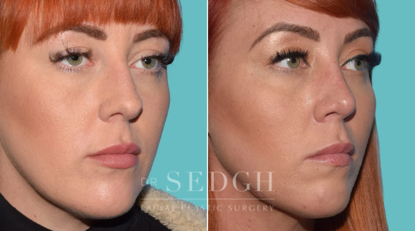 Patient 38 before Facial Fillers, view 1