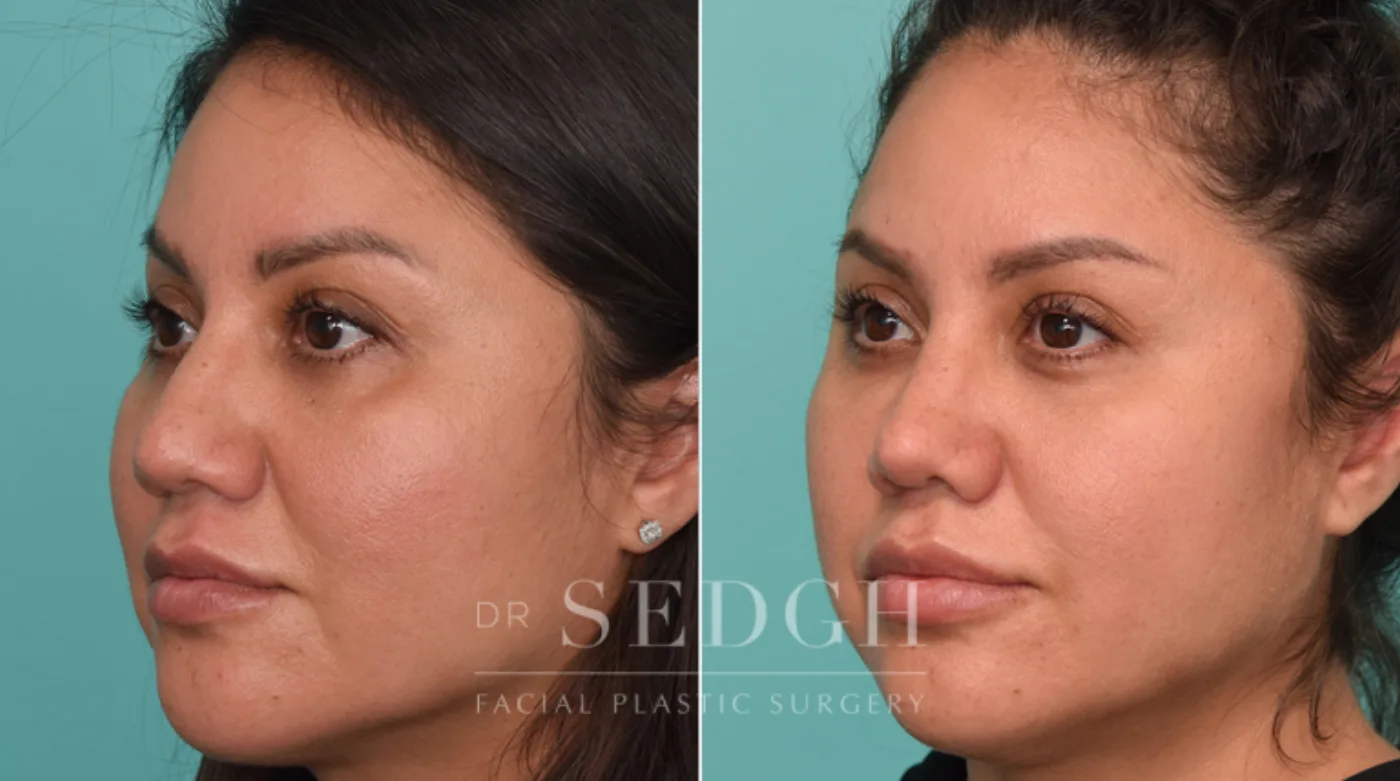 Patient 282 before Hispanic Rhinoplasty, view 1
