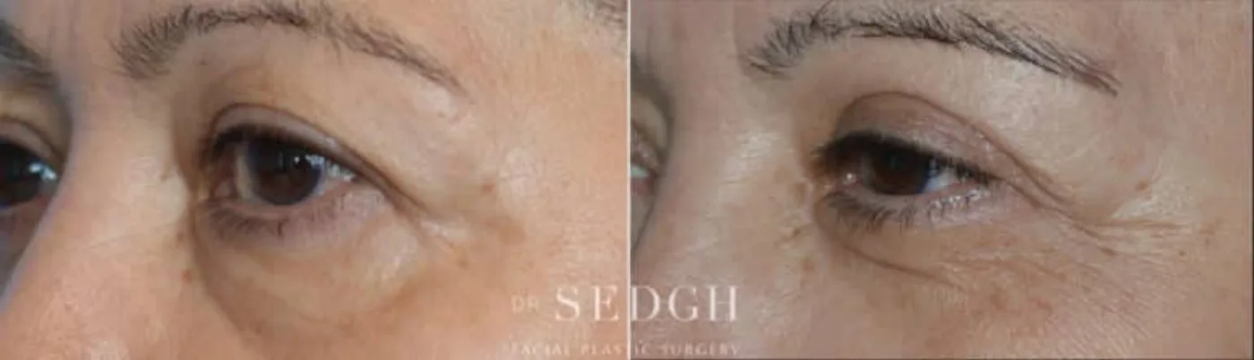 Patient 5 after Upper Blepharoplasty, view 1