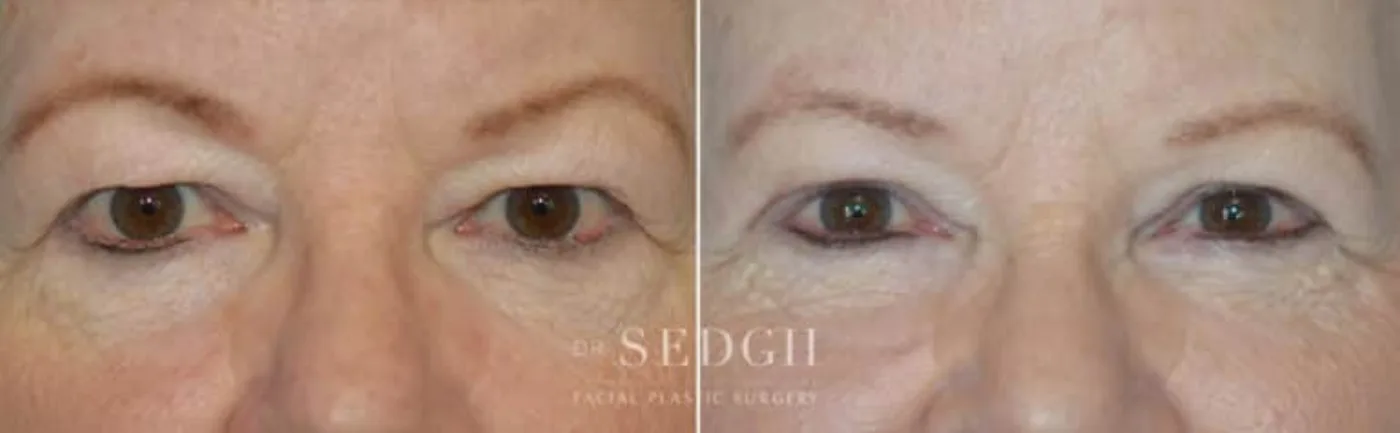 Patient 4 before Upper Blepharoplasty, view 1