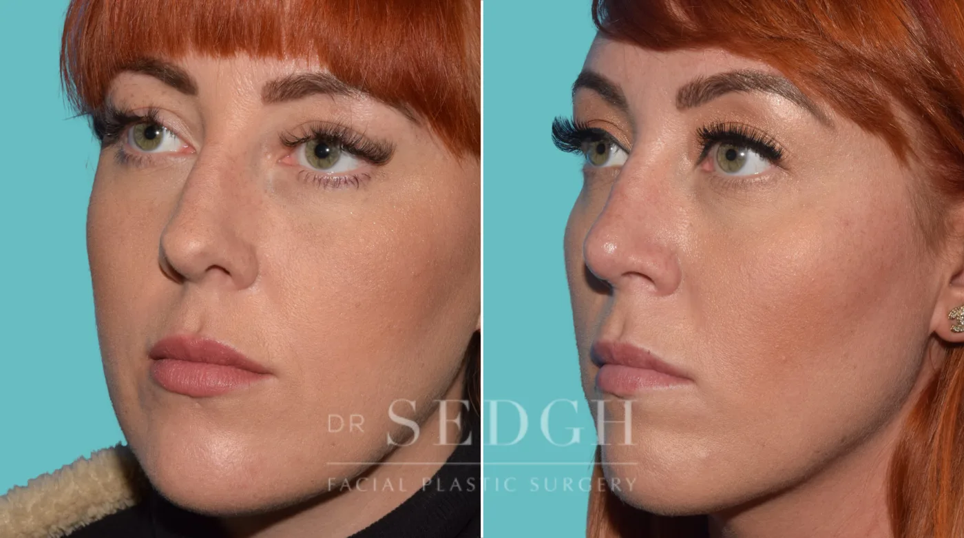 Patient 38 before Facial Fillers, view 2