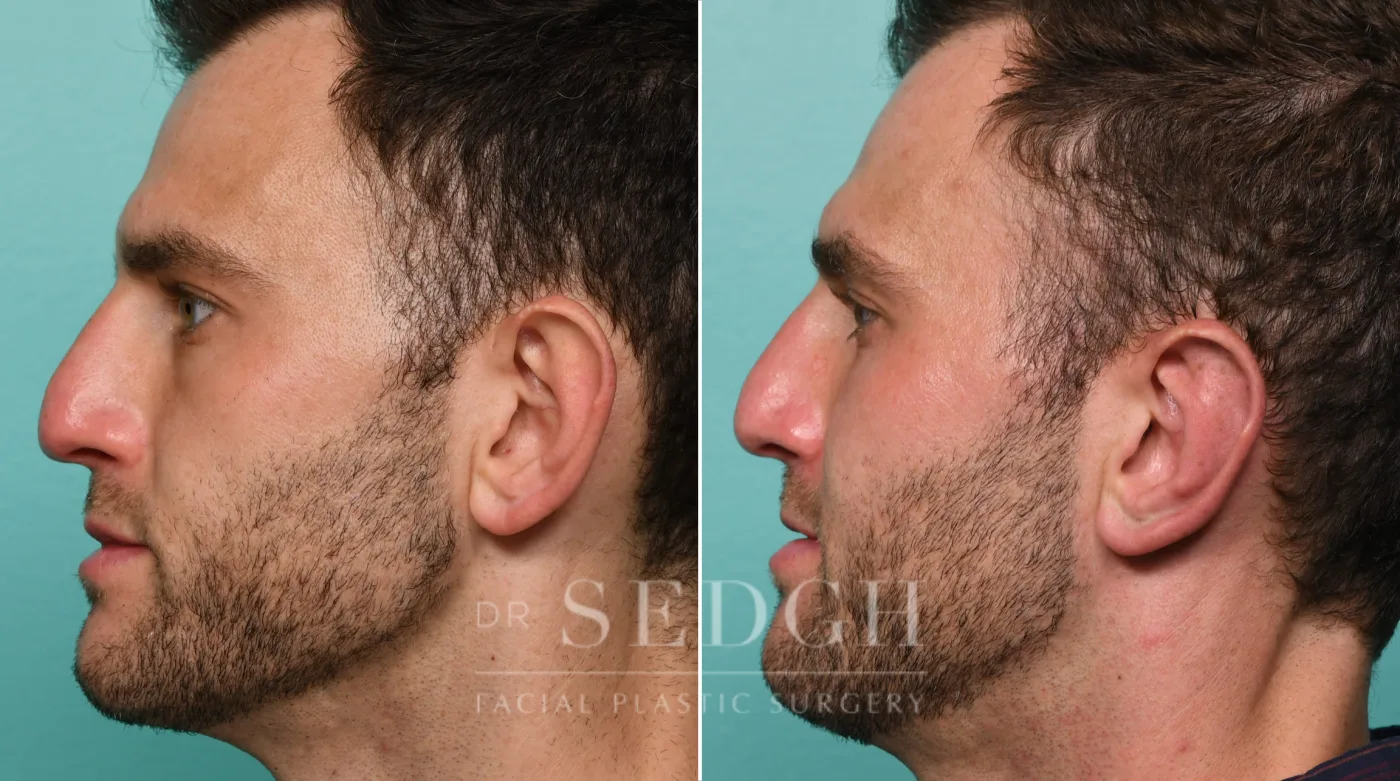 Patient 320 after Ear Pinning Surgery, view 2