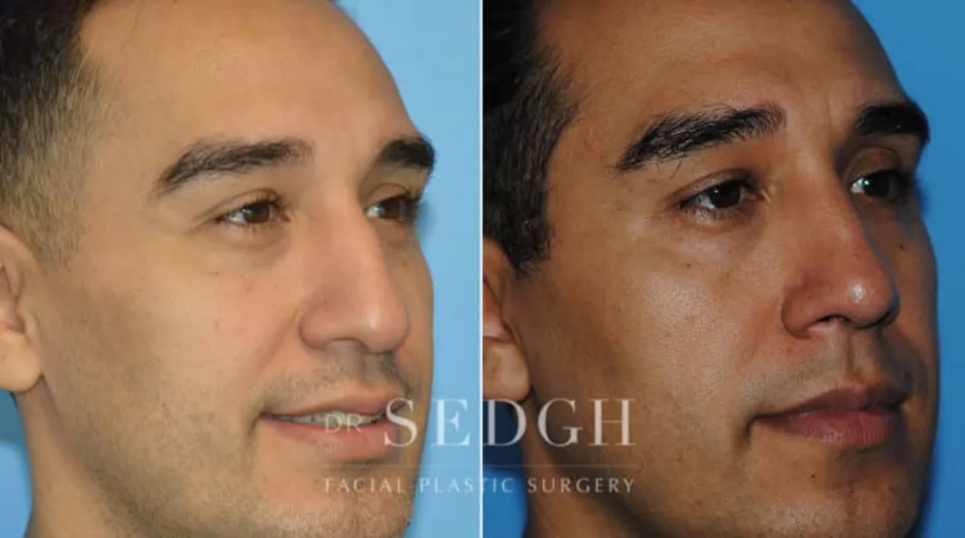 Patient 10 after Hispanic Rhinoplasty, view 1