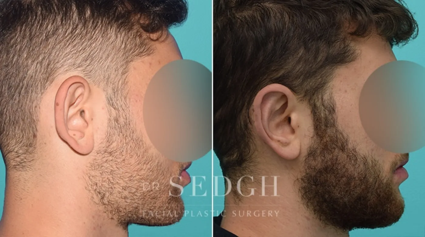 Patient 139 after Ear Pinning Surgery, view 1