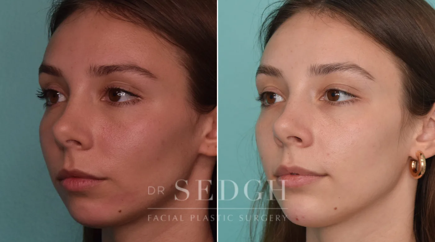 Patient 232 before Chin Filler, view 1