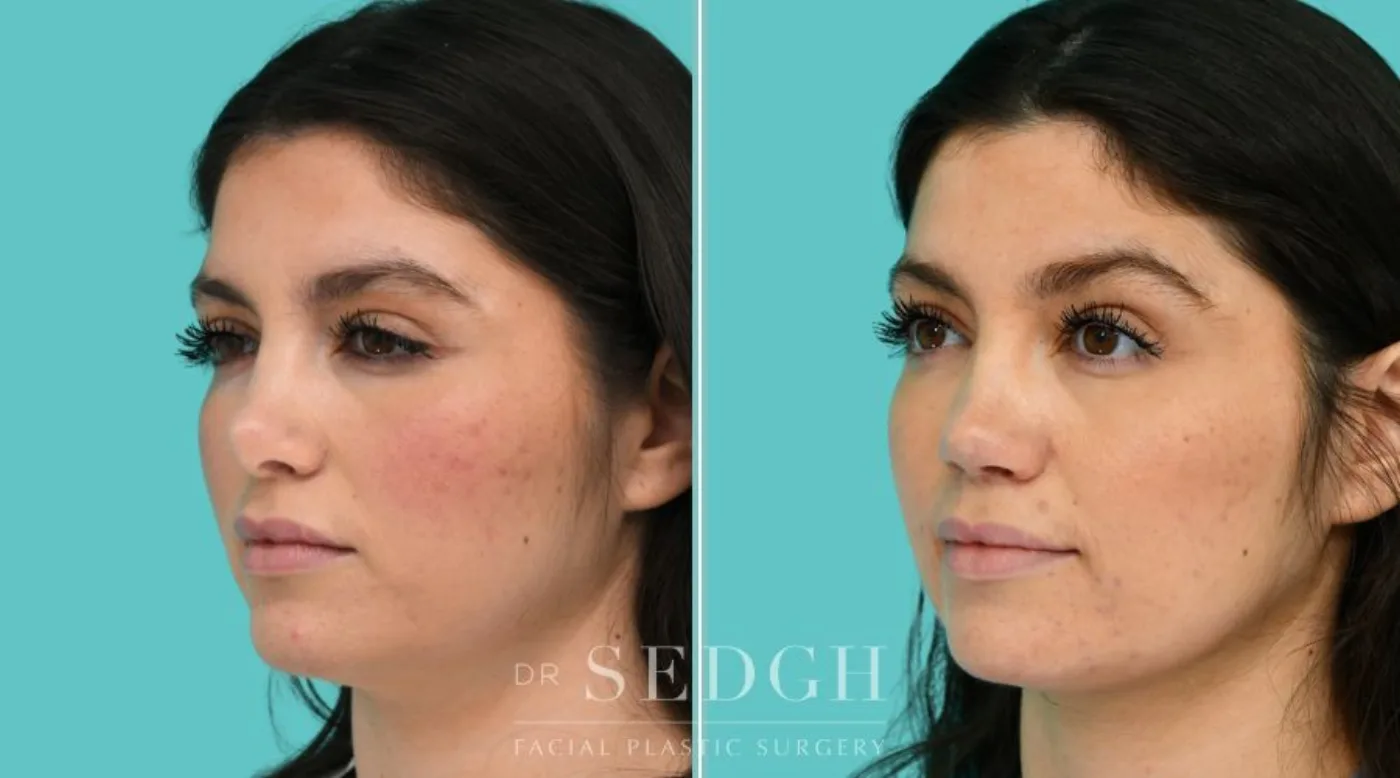 Patient 365 after Revision Rhinoplasty, view 2