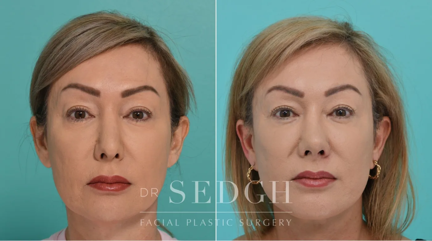 Patient 341 after Face Lift, view 3