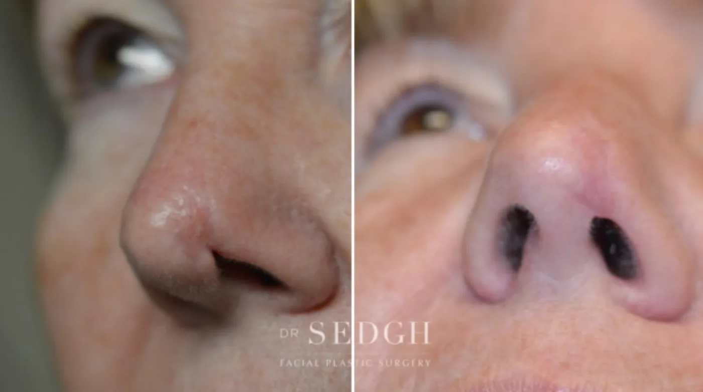 Patient 4 before Scar Revision, view 1