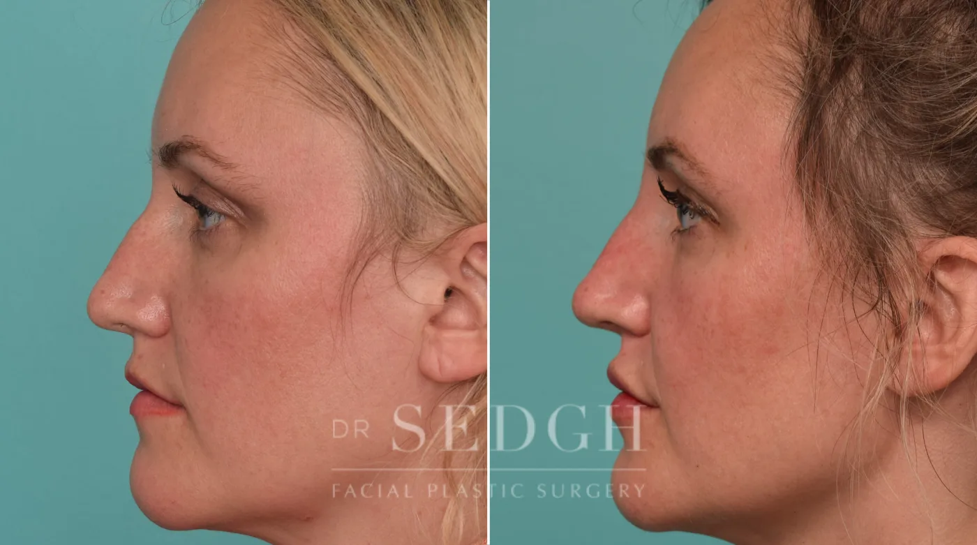 Patient 221 after Liquid Rhinoplasty, view 1